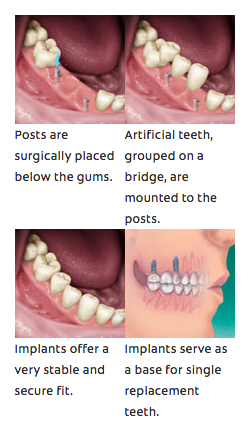 Nehl Dental - What Are Dental Implants? - Nehl Dental